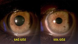 Anizokori-Göz Bebeklerinin Farklı Büyüklükte Olması-Adiie Tonik Pupilla