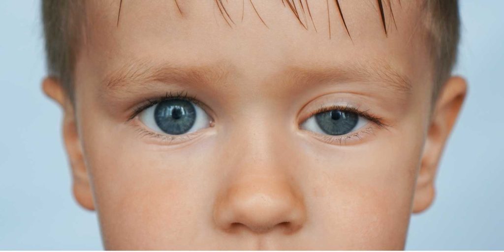 Çocuklarda Göz Kapak Düşüklüğü-Konjenital Pitosiz