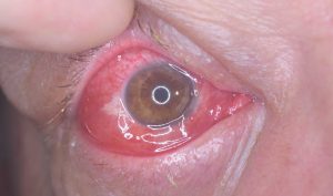 Göz Allerjisi-Allerjik Konjunktivit