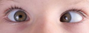 Şaşılık-Göz Kayması-Bebeklerde Göz Kayması