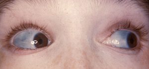Mavi Sklera-Mavi Göz