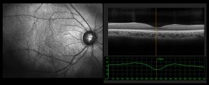 Optik Koherens Tomografi (OCT Testi)