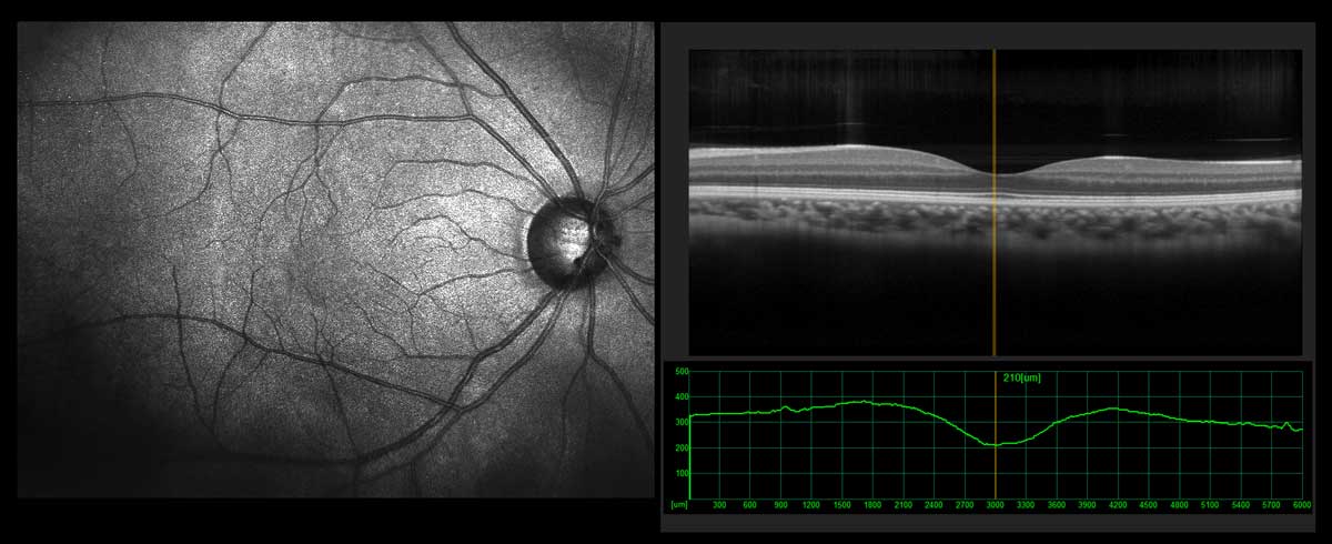oct様 OCT Testi (Optik Koherens Tomografi) - Doç. Dr. Fatih Çakır Gündoğan