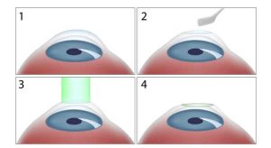 PRK Lazer Göz Ameliyatı-Göz Çizdirme