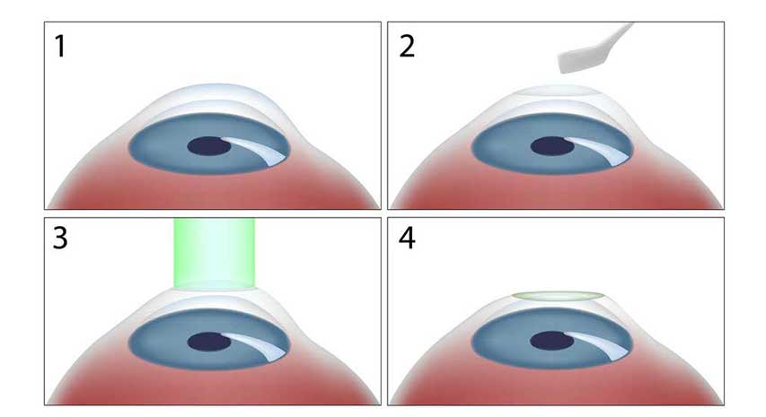 PRK Lazer Göz Ameliyatı-Göz Çizdirme