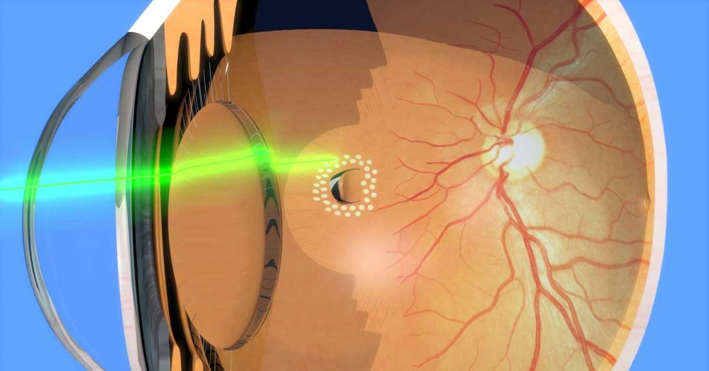 Retina Yırtığı ve Argon Lazer Uygulaması