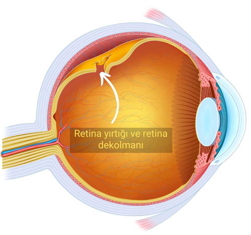 Retinada Yırtık ve Retina Dekolmanı