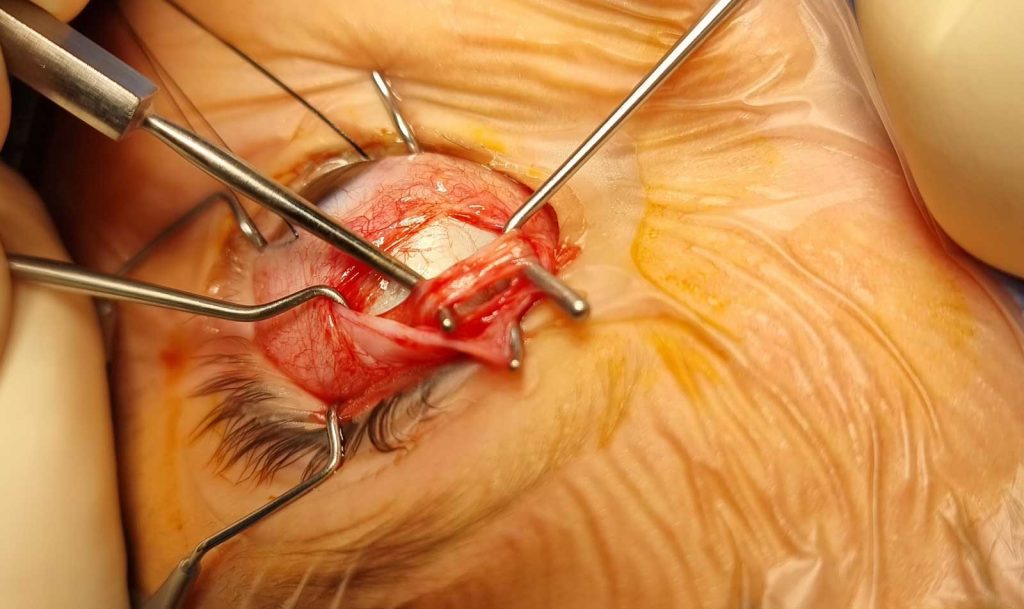 Şaşılık Ameliyatı-Göz Kayması Ameliyatı