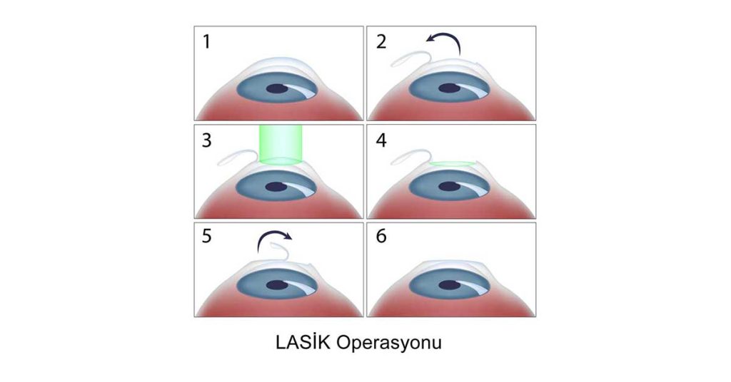 LASIK Lazer Göz Ameliyatı-Göz Çizdirme