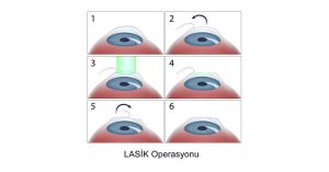 En İyi Lazer Göz Ameliyatı Yöntemi