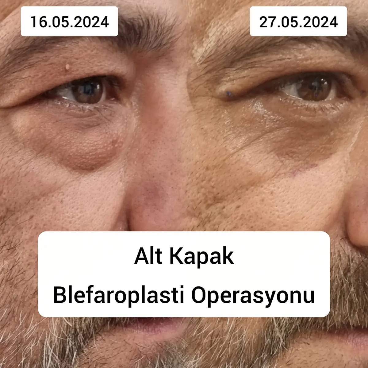 Alt Göz Kapağı Torbalanması Ameliyatı Nasıl Yapılır?